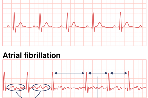 New AI Model Significantly Improves Detection of Atrial Fibrillation