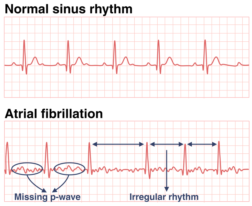 New AI Model Significantly Improves Detection of Atrial Fibrillation